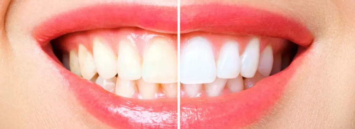 Teeth Whitenin Treatments in Turkey